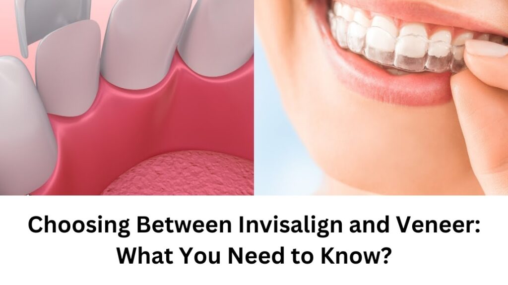 Choosing Between Invisalign and Veneer What You Need to Know